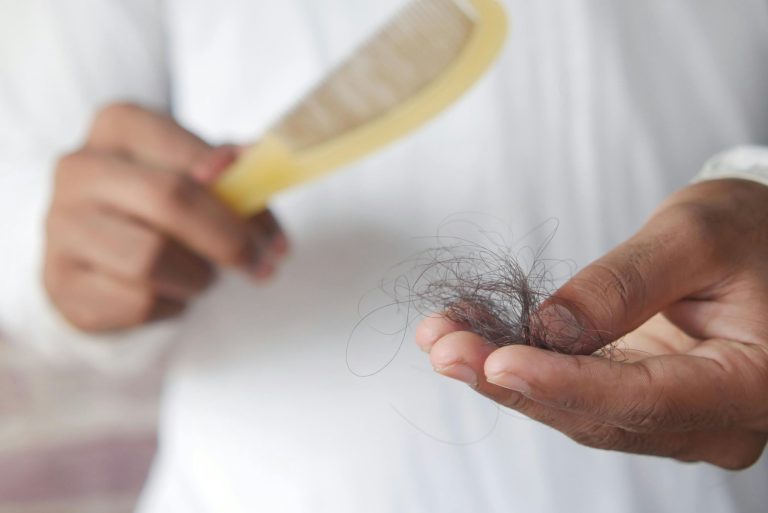 woman holding hair brush with noticeable hair loss in hand